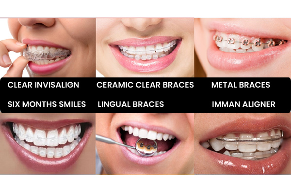 Braces Orthodontic Treatment