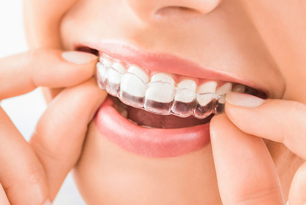 Invisible/Clear Braces