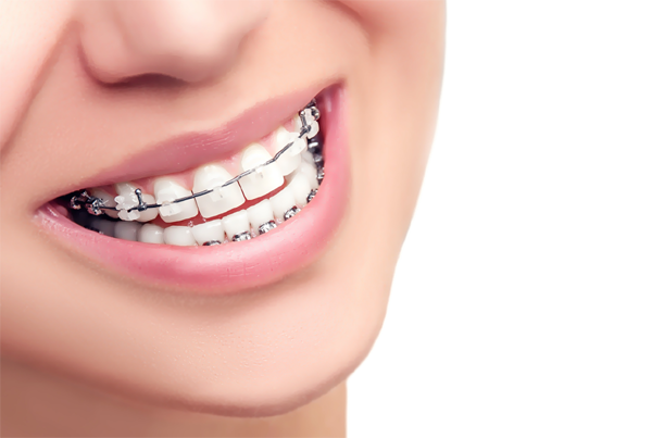 Ceramic Dental Braces