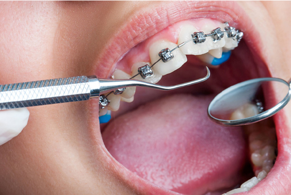 Straightening Teeth (Conventional Braces)