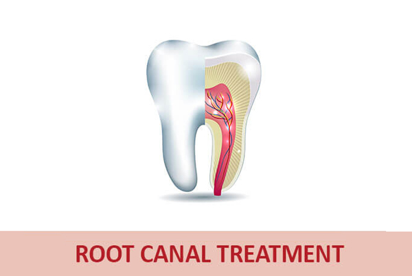 Advanced Root Canal Treatment