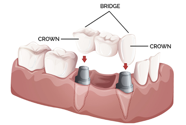 Prosthodontics - Crowns, Bridges and Dentures
