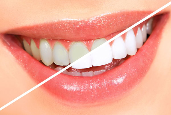 In-Office Bleaching