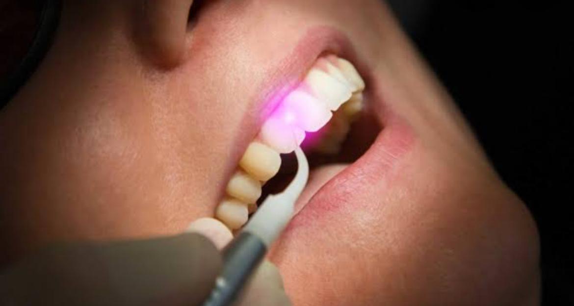 Laser Dentistry 