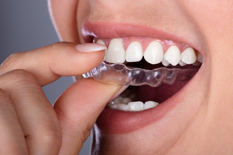Invisalign Aligners