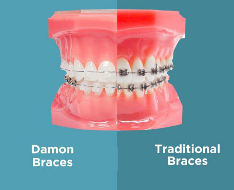 Damon Braces