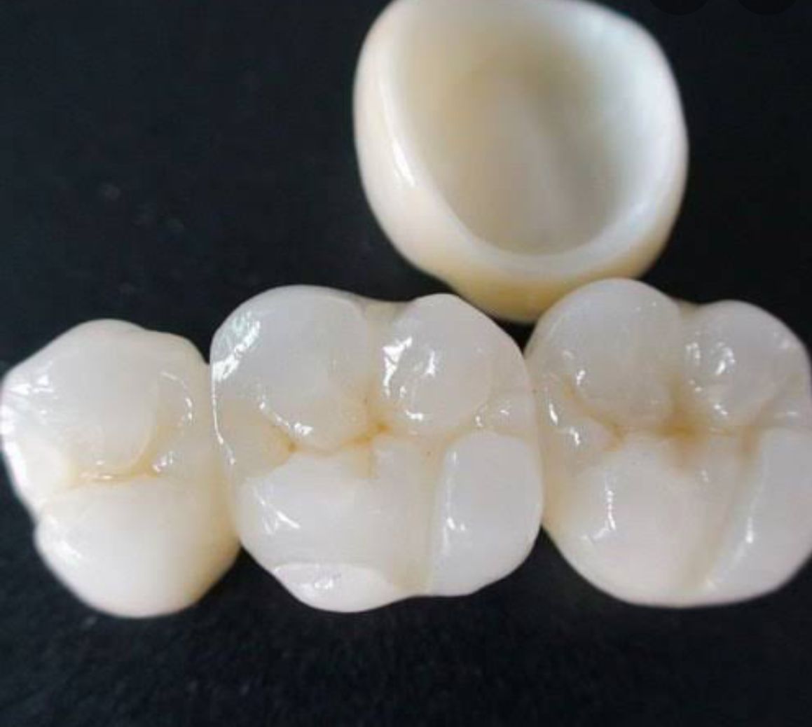 Zirconia Crowns with Digital Scanning
